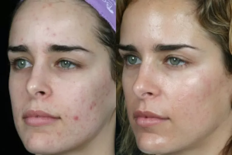 Cosurile din zona dintre sprancene indica probleme presum stresul, depresia si oboseala