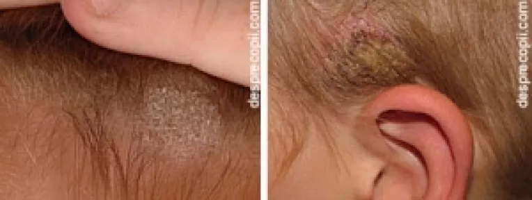 Neurodermatita se manifesta sub forma unor portiuni de piele solzoasa care apar la nivelul capului, pe breate, picioare si la incheieturi