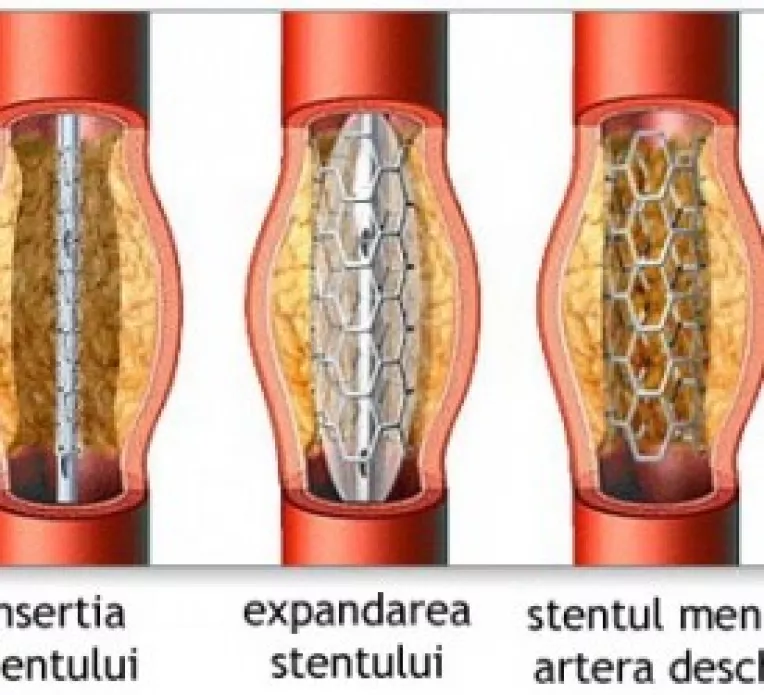 Stenturile golesc buzunarele asiguratilor